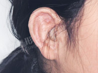 耳外伤缺损三大分类